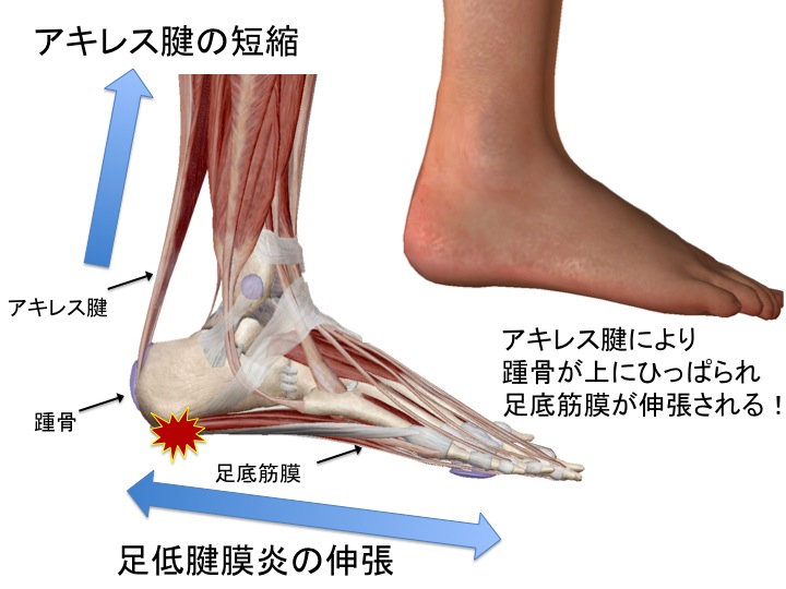 足の裏が痛い 足底腱膜炎 はるやま鍼灸整骨院 公式ブログ 神戸市北区の鍼灸整骨院 はるやま鍼灸整骨院
